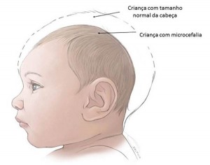 microcefalia-zika-virus
