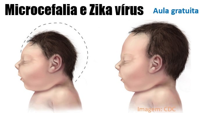 Microcefalia e Zika Vírus